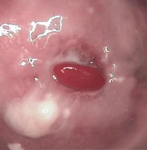 宮頸息肉復(fù)發(fā)的病因