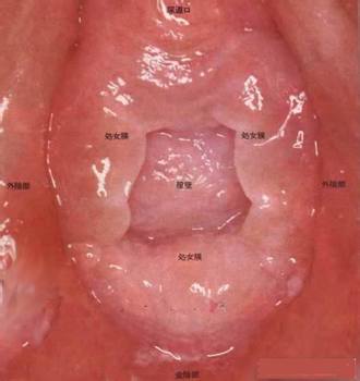 婦科過(guò)敏性陰道炎總復(fù)發(fā)原因