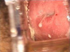 預防外陰道炎復發的方法