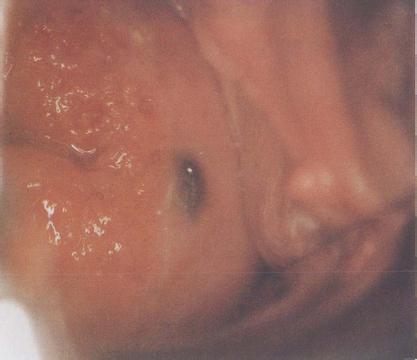 引發宮頸炎的病因