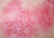 帶狀皰疹的臨床癥狀