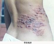 海極光療法 恢復幸福生活