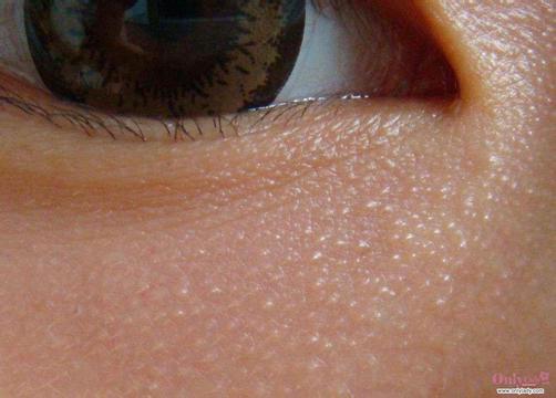 皮炎有哪些癥狀