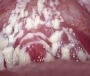 陰道炎的典型癥狀有什么