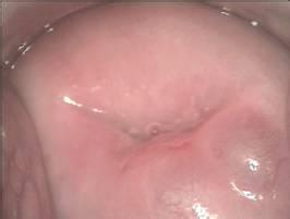 慢性宮頸炎的癥狀表現有哪些