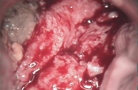 患上附件炎通常有哪些表現