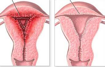 子宮內膜炎早期癥狀