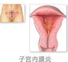 子宮內膜炎的病因