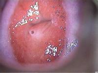 宮頸糜爛為何久治不愈