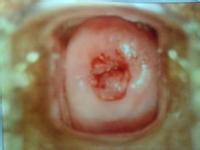 引起盆腔積液的原因