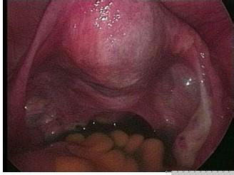 徹底擺脫盆腔積液的困擾