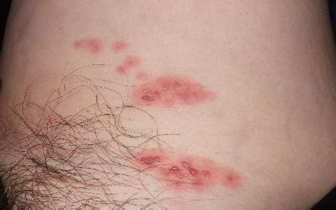 生殖器皰疹病因是什么？