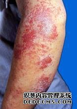 濕疹有哪四大危害?