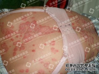 女性患牛皮癬的癥狀表現