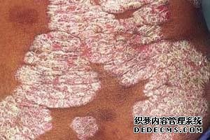 兒童患有銀屑病病因