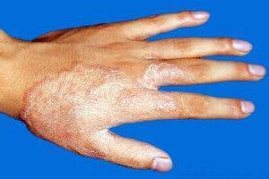 手足癬有哪些預防措施