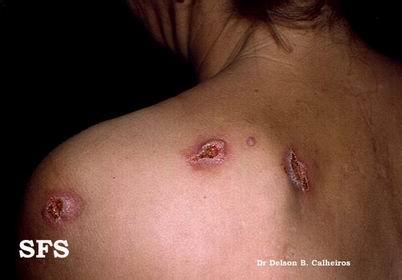 梅毒臨床癥狀表現