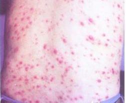 梅毒治療期間需要注意哪些？