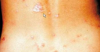 梅毒治愈案例解讀