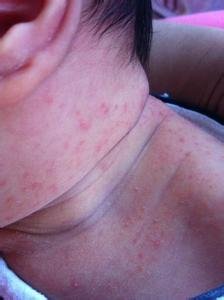 小兒患有藥疹該怎么辦?