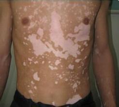 泛發(fā)型白癜風癥狀表現(xiàn)