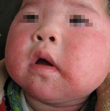 正確診斷小兒牛皮癬的方法