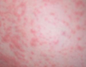 特應性皮炎的癥狀表現